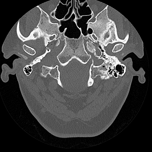 File:Bilateral ossifications of the external auditory canal (Radiopaedia 15233-15076 Axial bone window 20).jpg