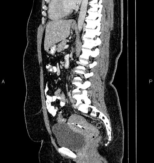 Bilateral ovarian dermoid cysts (Radiopaedia 85785-101603 D 52).jpg