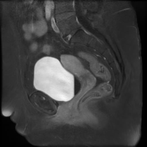 File:Bilateral ovarian dermoid cysts (Radiopaedia 90152-107338 Sagittal T1 C+ 13).jpg