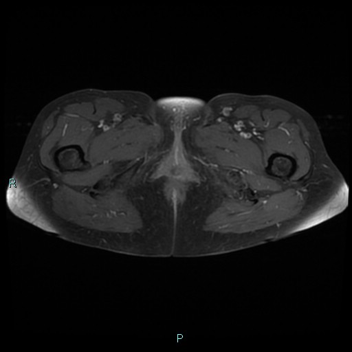 File:Bilateral ovarian fibroma (Radiopaedia 44568-48293 Axial T1 C+ fat sat 32).jpg