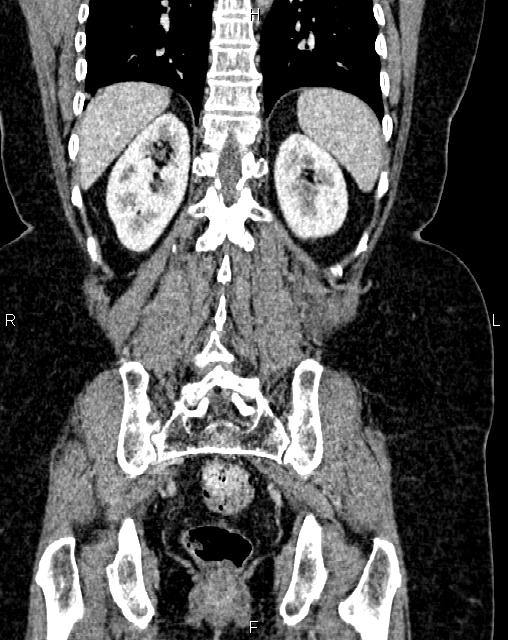 Bilateral ovarian serous cystadenocarcinoma (Radiopaedia 86062-101989 D 40).jpg
