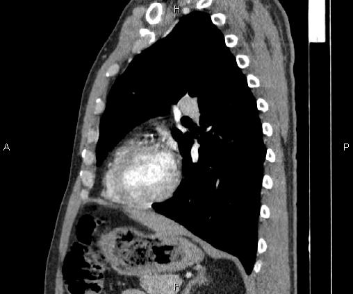 Bilateral pulmonary AVM (Radiopaedia 83134-97505 D 74).jpg