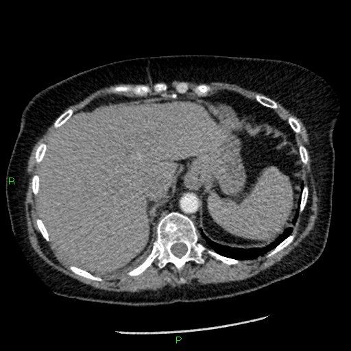 Bilateral pulmonary emboli (Radiopaedia 32700-33669 Axial C+ CTPA 96).jpg