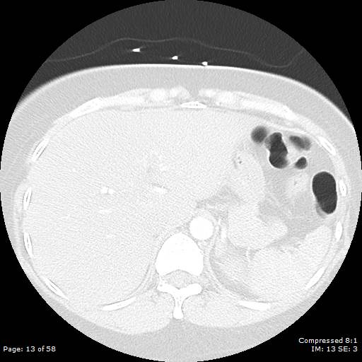 Bilateral pulmonary emboli with Hampton hump sign (Radiopaedia 54070-60246 Axial lung window 13).jpg