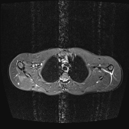 File:Bilateral spinoglenoid notch ganglion cysts (Radiopaedia 29577-30082 E 11).jpg