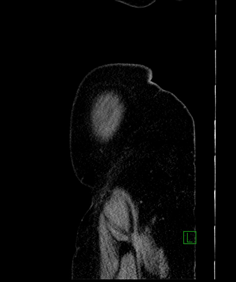 Bilateral sporadic synchronous clear cell renal cell carcinoma (Radiopaedia 85035-100575 E 8).jpg