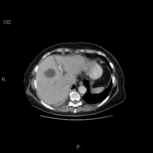 File:Biloma with drainage into the colon (Radiopaedia 20032-20068 A 13).jpg