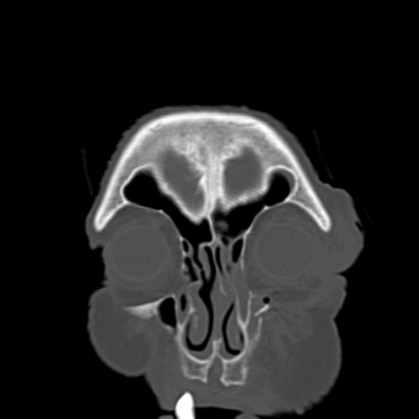 Biparietal osteodystrophy (Radiopaedia 46109-50463 Coronal bone window 19).jpg