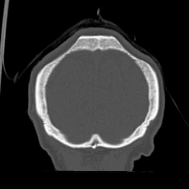 Biparietal osteodystrophy (Radiopaedia 46109-50463 Coronal bone window 93).jpg