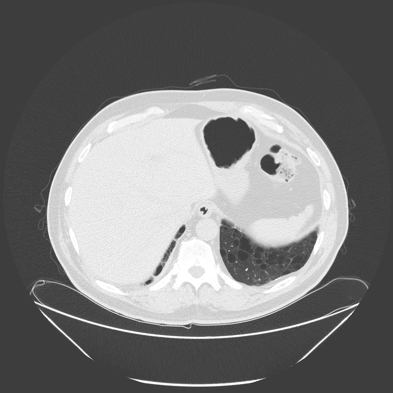 Birt-Hogg-Dubé syndrome (Radiopaedia 52578-58491 Axial lung window 56).jpg
