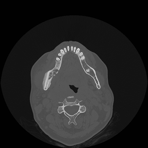 File:Bisphosphonate-related osteonecrosis of the jaw (Radiopaedia 71324-81642 Axial bone window 61).jpg