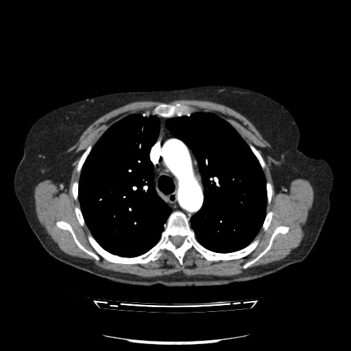 File:Bladder tumor detected on trauma CT (Radiopaedia 51809-57609 A 36).jpg