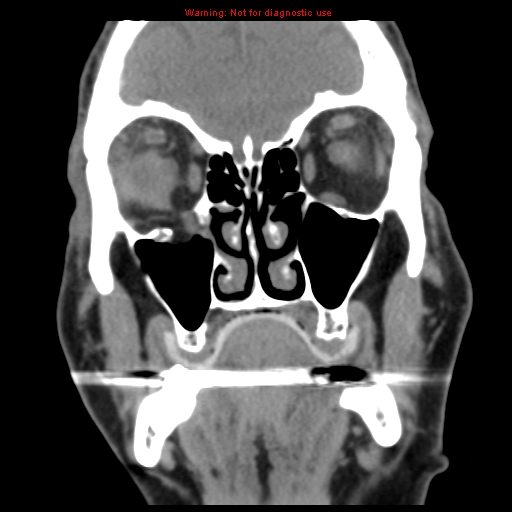 File:Blowout fracture with inferior rectus entrapment (Radiopaedia 12418-12673 Coronal non-contrast 10).jpg