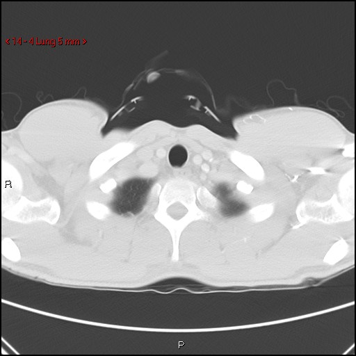 File:Blunt chest trauma - pulmonary interstitial emphysema and pneumomediastinum (Radiopaedia 20666-20552 Axial lung window 4).jpg