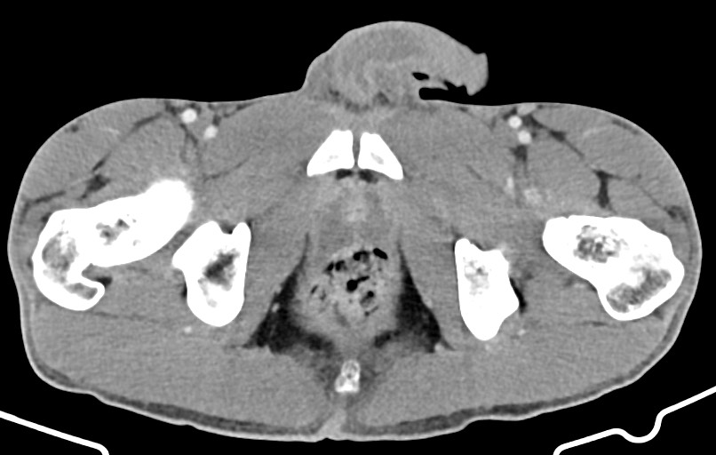 Blunt injury to the small bowel (Radiopaedia 74953-85987 A 197).jpg