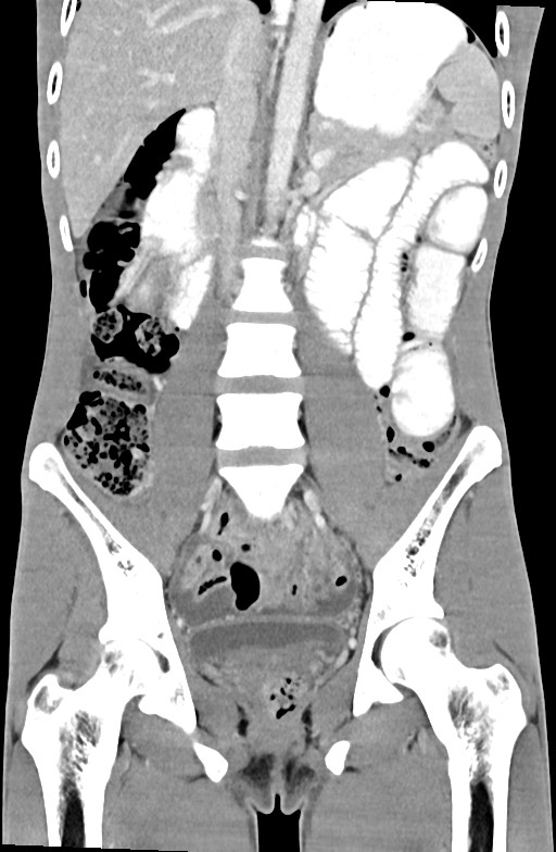 Blunt injury to the small bowel (Radiopaedia 74953-85987 B 54).jpg