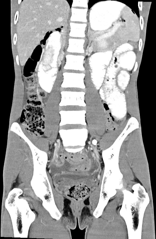 Blunt injury to the small bowel (Radiopaedia 74953-85987 B 59).jpg