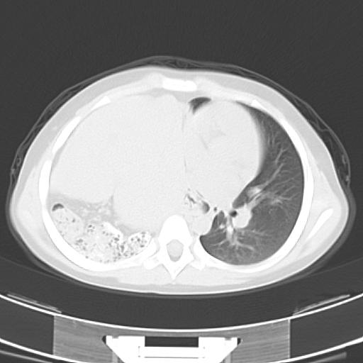 File:Bochdalek diaphragmatic hernia (Radiopaedia 38866-41059 Axial lung window 13).jpg