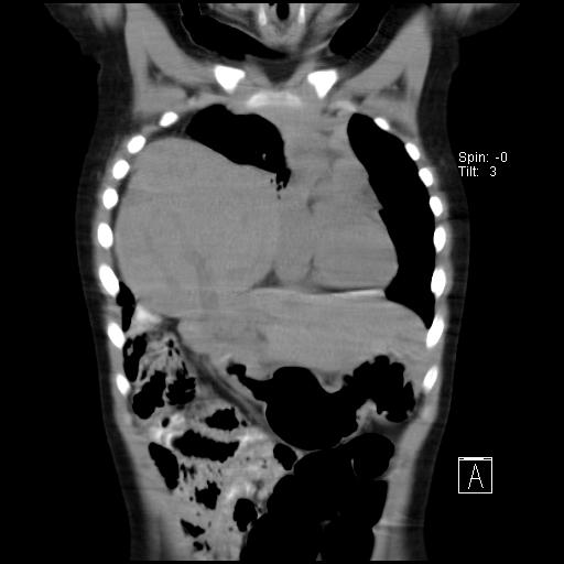 File:Bochdalek diaphragmatic hernia (Radiopaedia 38866-41059 Coronal liver window 7).jpg