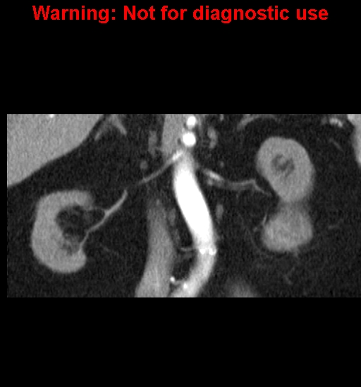 File:Bosniak renal cyst - type IV (Radiopaedia 23402-23466 C 20).jpg
