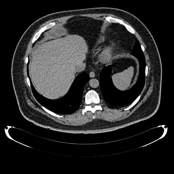 Bosniak renal cyst - type IV (Radiopaedia 24244-24518 Axial non-contrast 44).jpg