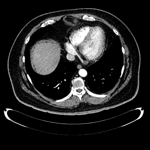 Bosniak renal cyst - type IV (Radiopaedia 24244-24518 B 11).jpg