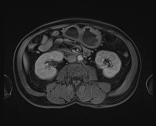 Bouveret syndrome (Radiopaedia 61017-68856 Axial T1 C+ fat sat 50).jpg