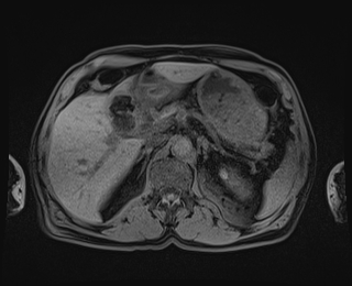 Bouveret syndrome (Radiopaedia 61017-68856 Axial T1 fat sat 27).jpg