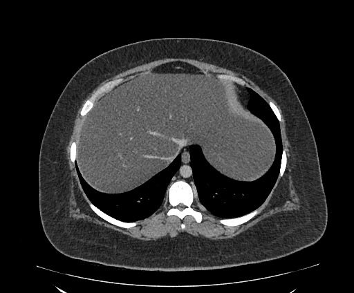 Bowel and splenic infarcts in acute lymphocytic leukemia (Radiopaedia 61055-68913 A 23).jpg