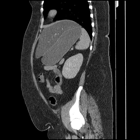 Bowel and splenic infarcts in acute lymphocytic leukemia (Radiopaedia 61055-68913 C 27).jpg