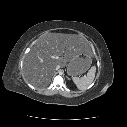 Bowel and splenic infarcts in acute lymphocytic leukemia (Radiopaedia 61055-68915 A 41).jpg