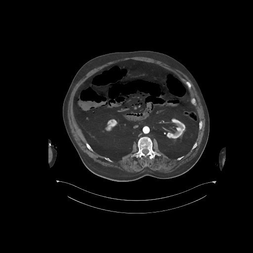 File:Bowel ischemia secondary to SMA occlusion with extensive portomesenteric venous gas (Radiopaedia 54656-60871 A 42).jpg