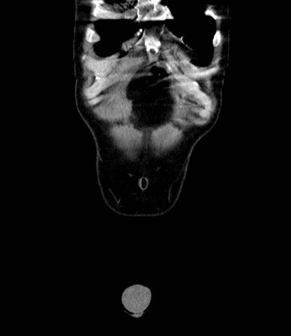 Bowel obstruction from colon carcinoma (Radiopaedia 22995-23028 C 4).jpg