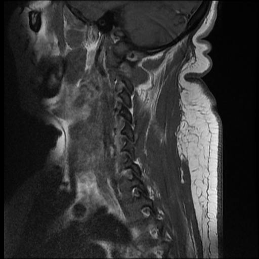 File:Brachial plexopathy (Radiopaedia 21844-21806 Sagittal T1 C+ 2).jpg