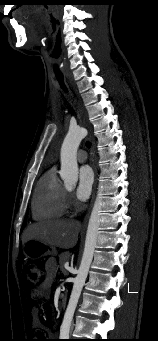 Brachiocephalic trunk pseudoaneurysm (Radiopaedia 70978-81191 C 52).jpg