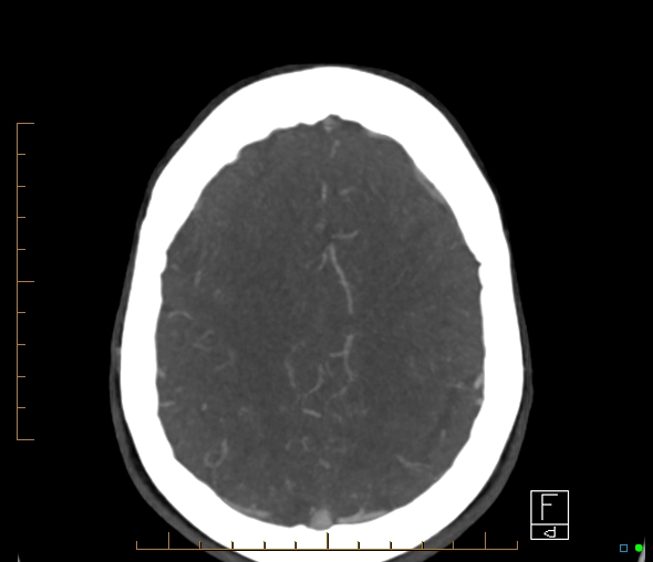 Brachiocephalic trunk stenosis (Radiopaedia 87242-103519 A 16).jpg