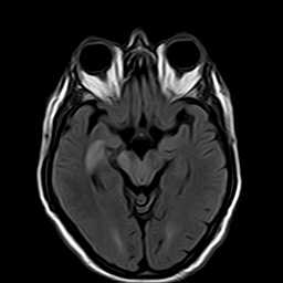 File:Brain abscess complicated by intraventricular rupture and ventriculitis (Radiopaedia 82434-96571 Axial FLAIR 9).jpg