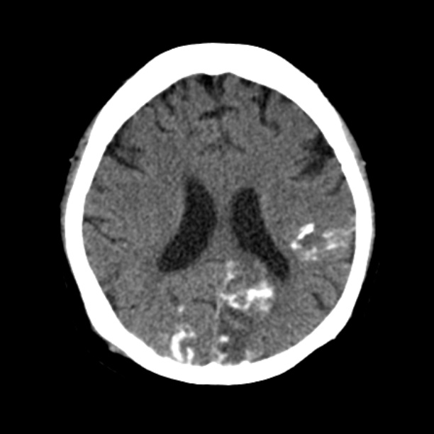 Brain cortical laminar necrosis (Radiopaedia 25822-25971 Axial non-contrast 28).jpg