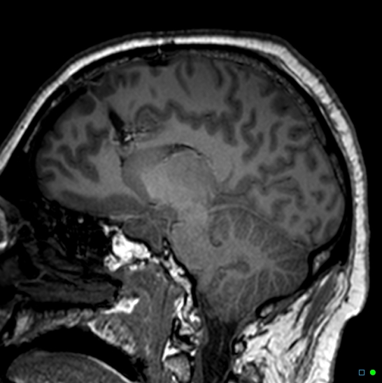 File:Brain death on MRI and CT angiography (Radiopaedia 42560-45689 Sagittal T1 35).jpg