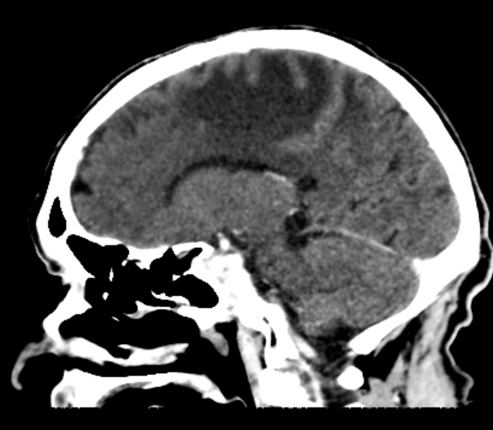 Brain metastases from lung cancer (Radiopaedia 27849-28092 Sagittal C+ delayed 27).jpg