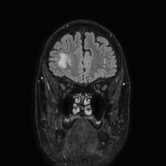 Brain metastases from lung cancer (Radiopaedia 83839-99028 Coronal FLAIR 15).jpg