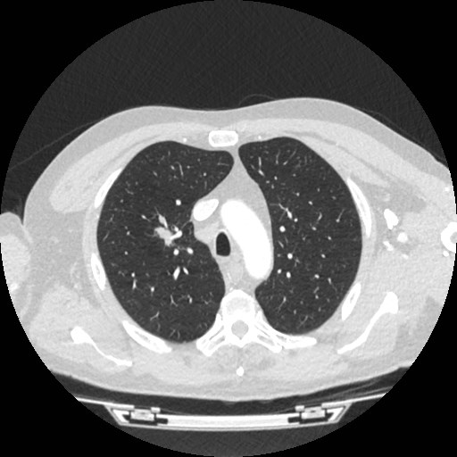 File:Brain metastases from lung cancer (Radiopaedia 83839-99030 Axial lung window 12).jpg