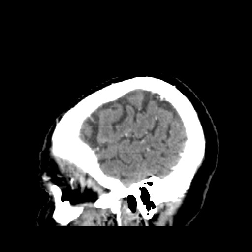 Brain metastasis (Radiopaedia 42617-45760 D 3).jpg