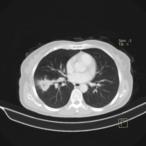 Brain metastasis as initial presentation of non-small cell lung cancer (Radiopaedia 65122-74127 Axial lung window 27).jpg