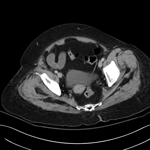 File:Breast carcinoma with pathological hip fracture (Radiopaedia 60314-67974 B 63).jpg