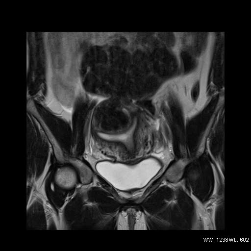 File:Broad ligament fibroid (Radiopaedia 49135-54241 Coronal T2 10).jpg