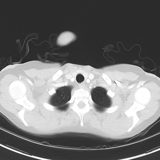 Bronchial atresia (Radiopaedia 73677-84470 Axial lung window 8).jpg