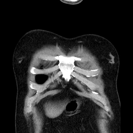 Bronchial carcinoid tumor (Radiopaedia 67377-76764 C 16).jpg