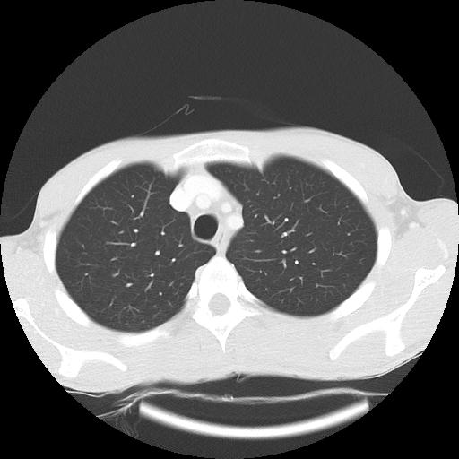 Bronchial carcinoid tumor causing right lower lobe collapse (Radiopaedia 83495-98594 Axial lung window 9).jpg