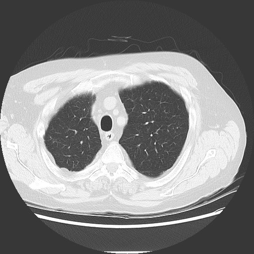 File:Bronchial stenosis - lung transplant (Radiopaedia 73133-83848 Axial lung window 15).jpg